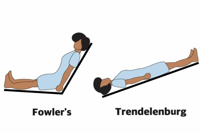 Fowlers og Trendelenburg